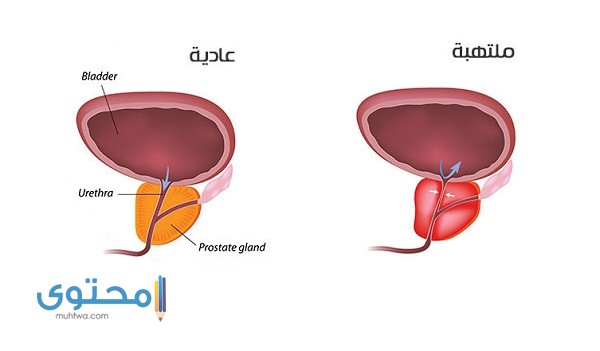 أعراض التهاب البروستاتا