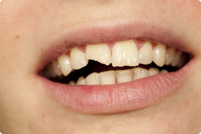 تفسير رؤية تكسير الأسنان والضرس في المنام