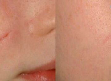 S طرق علاج اثار الجروح القديمة طبيعياً طرق إزالة أثار الخدوش في الوجه