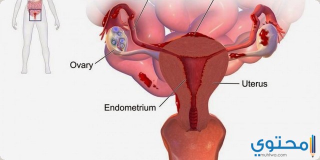 ادوية علاج بطانة الرحم المهاجرة