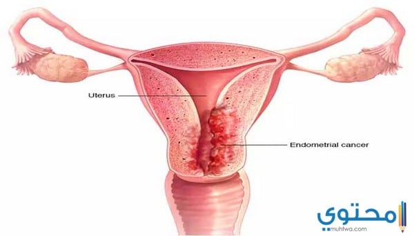 الرحم ما هي أعراض سرطان الرحم