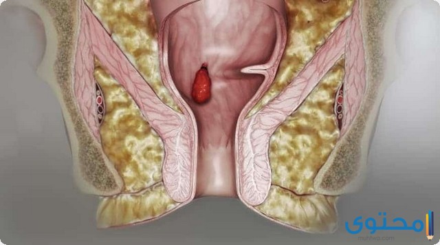 علاج البواسير الداخلية