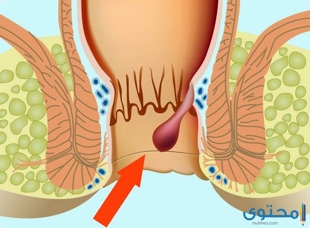 كيف تختفي البواسير الخارجية