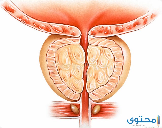 مدة الشفاء من التهاب البروستاتا