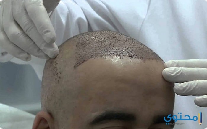 زراعة الشعر